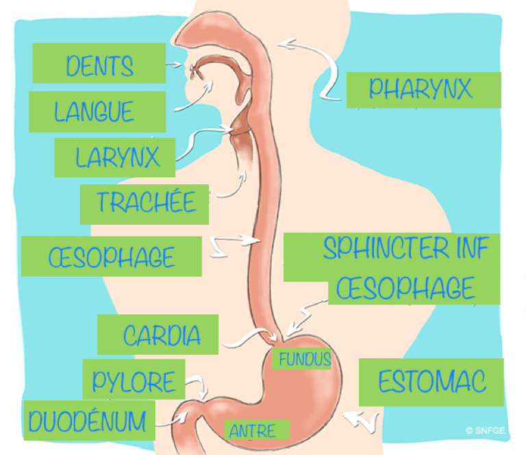 Gastrite: inflammation de la muqueuse de l'estomac